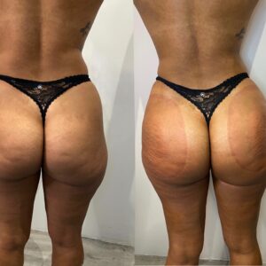 Belles fesses : Découvrez les secrets du lifting colombien